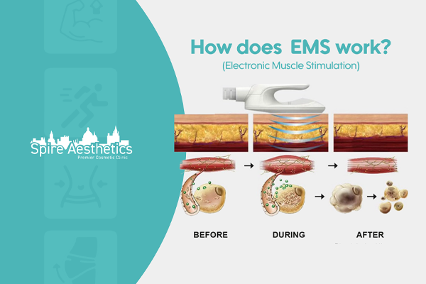 EMS treatment for post pregnancy weight loss treatment Bury
