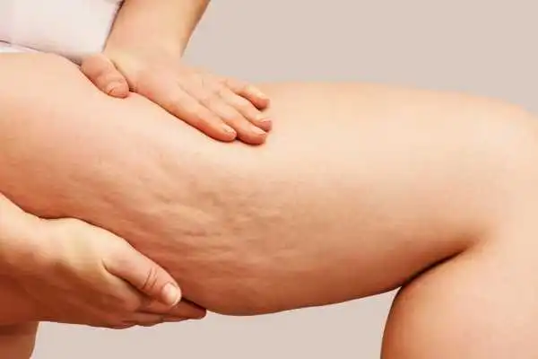 Image of woman showing leg with cellulite Bury
