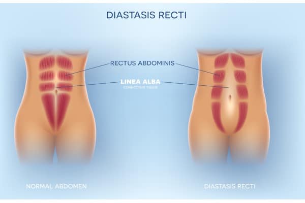 What Non-Surgical Options Are Available for Diastasis Recti Bury?