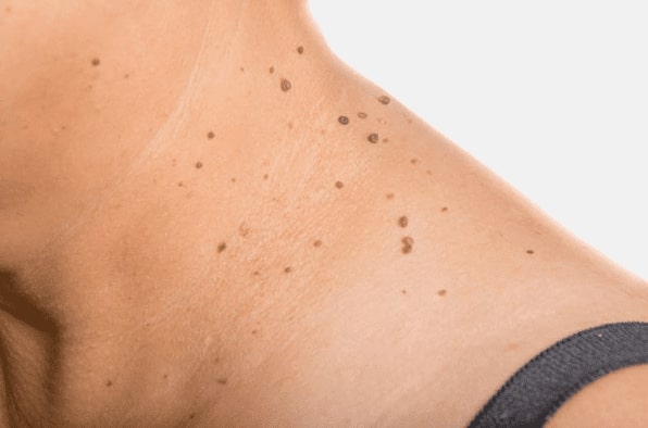 Are you looking for easy skin tag removal Bury - then contact Spire today!