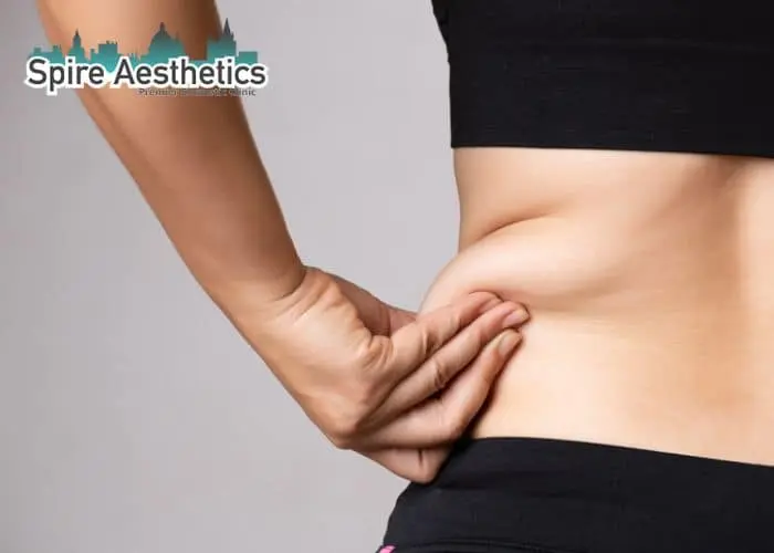 Image of woman pinching fat on their hips Bury. Fat Freezing treatment 