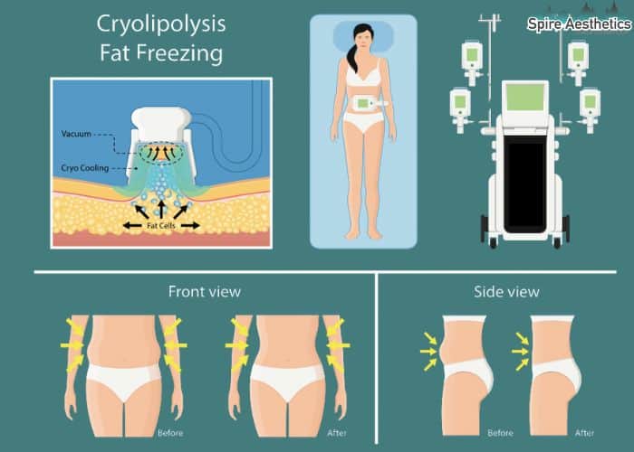 Image of diet and fat freezing combined for best results for Spire Aesthetics Bury