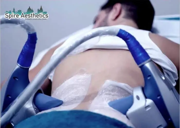 Man having fat freezing treatment done on love handles before a competitions Bury to create a sculpted look.