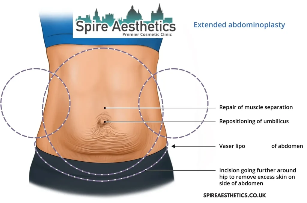Understanding Loose Skin After Gastric Band Bury Surgery and HIFU Treatment 