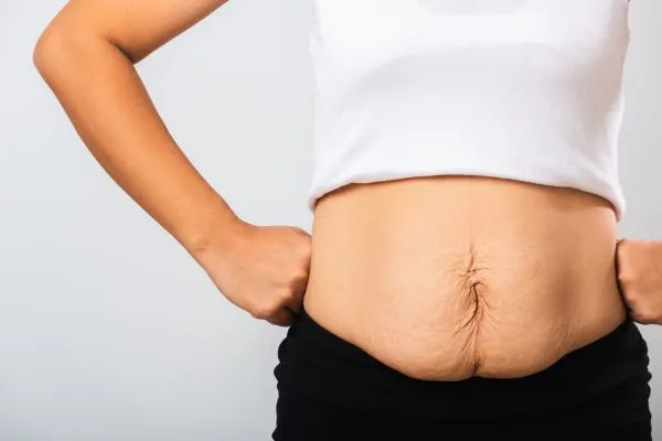 Image of a woman's stomach after weight loss with sagging skin following a gastric band Bury