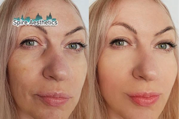 Morpheus8 Treatment Bury Before & After Results