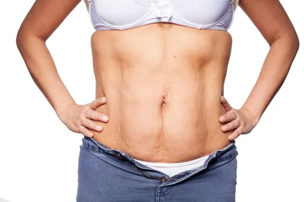 sagging skin on woman's stomach after weight loss injections Bury