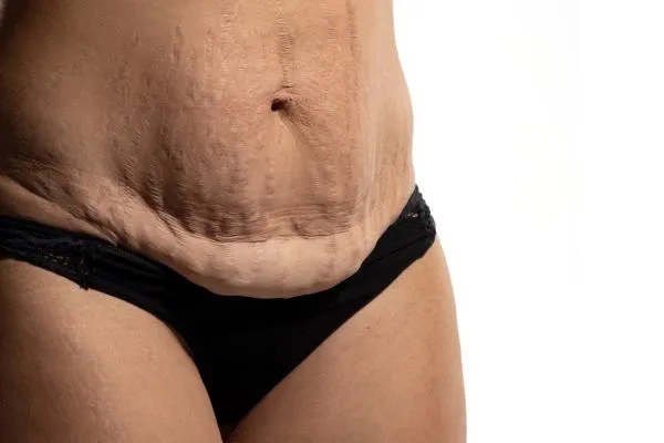 Image of womans stomach after weight loss injections Bury showing saggy skin