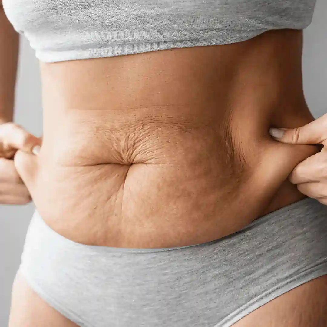 Is It Normal to Have Loose Skin After Pregnancy Bury?
